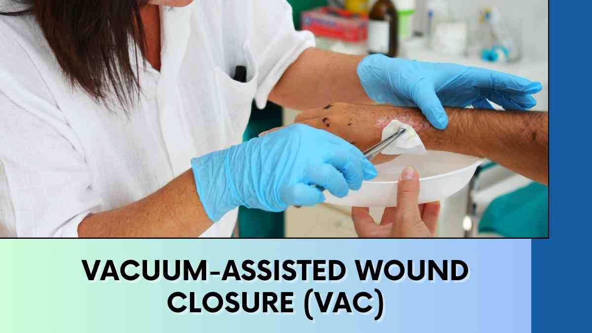 About Vacuum-Assisted Wound Closure (VAC)